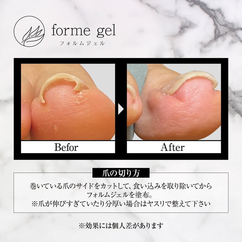 ❥新品未使用❥巻き爪用ジェル❥formegel❥巻き爪シール付 塗るだけ/簡単/巻き爪緩和フォルムジェル (@formegel