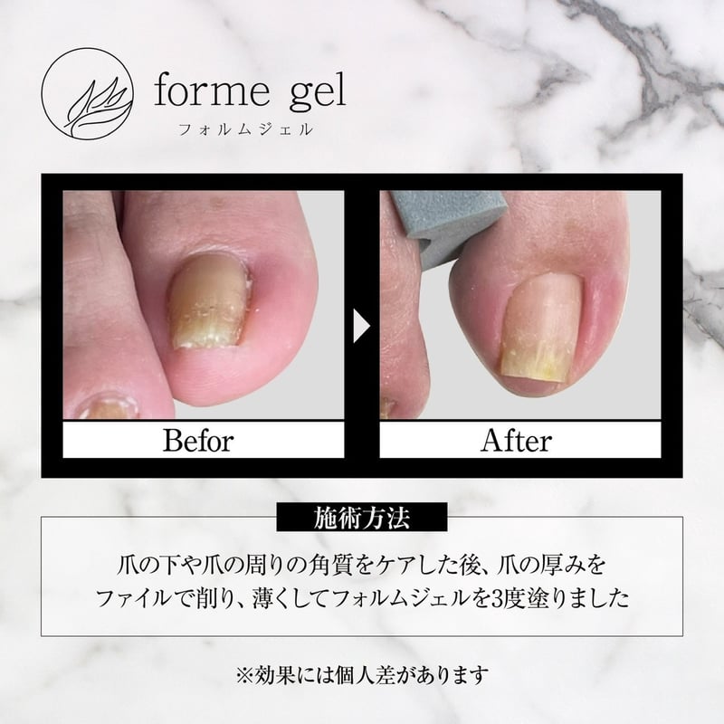簡単塗るだけ巻き爪ケア 2点セット フォルムジェル15ml＆UVLEDライト