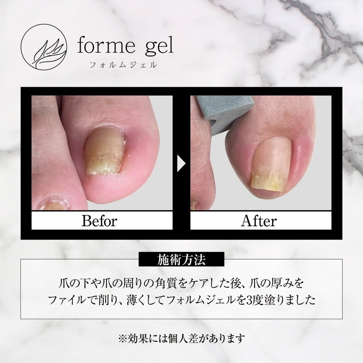 簡単塗るだけ巻き爪ケア 2点セット フォルムジェル15ml＆UVLEDライト