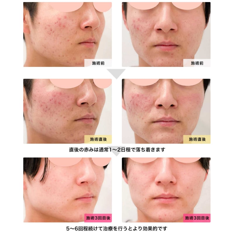 美品 リゼネレート　ダーマペン ダーマペン4 全顔1回 | Tokyo Private Clinic's STORE