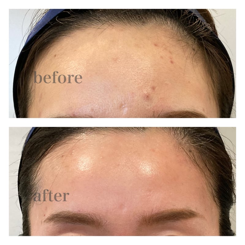 ダーマペン4 全顔1回 | Tokyo Private Clinic's STORE