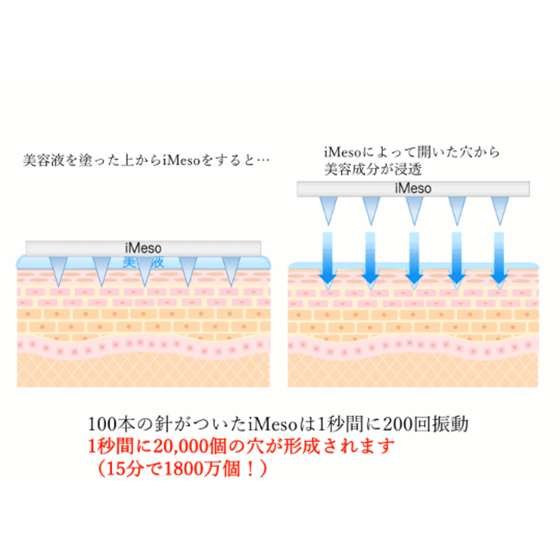 お得意様専用】iMeso(アイメソ)ダーマペン~(シルバー) | 美白の杜