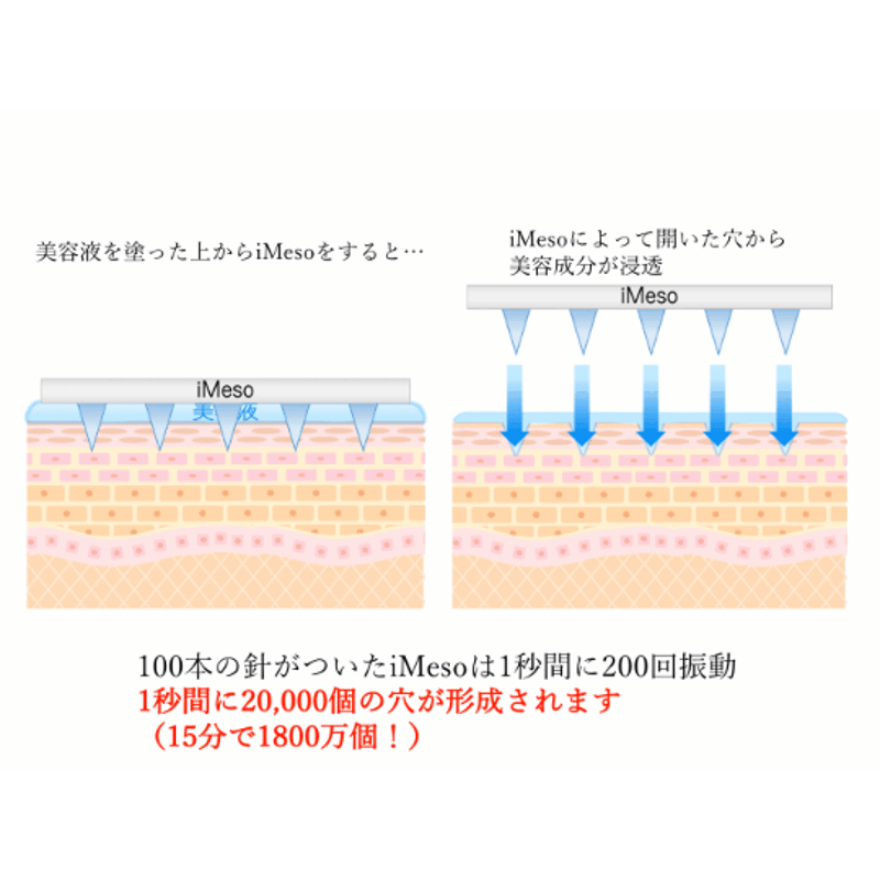 Meso アイメソ美顔器 - 脱毛・除毛