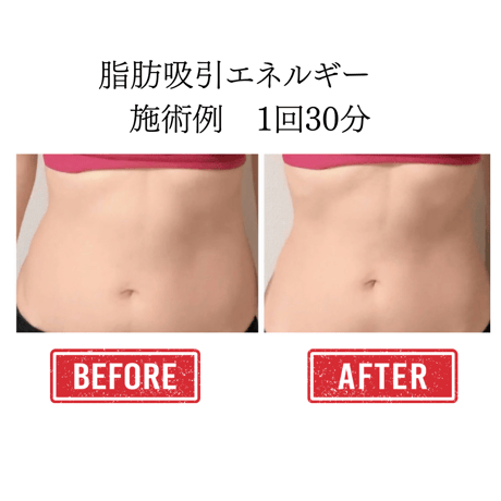 脂肪吸引エネルギー