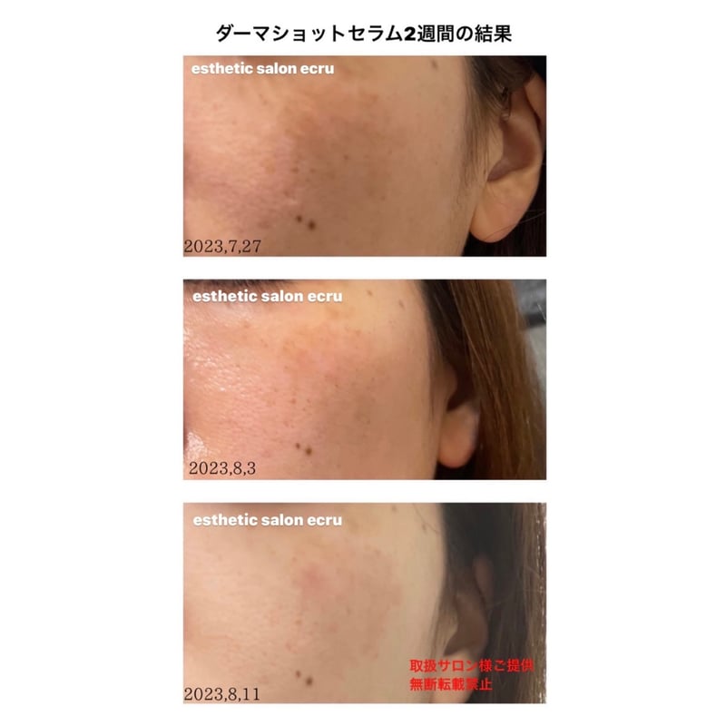 ダーマショットセラム 【正規取扱店】 | 【即日発送!】ダーマ ダーマショットセラム 【正規取扱店】 | 【即日発送!】ダーマ