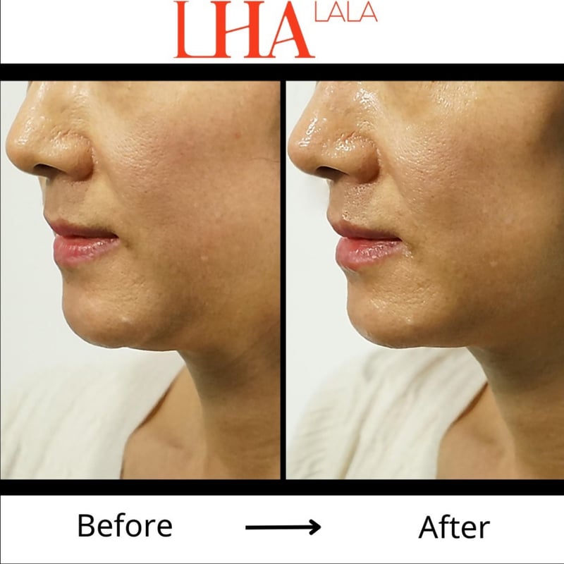 まとめ買い値引きあり　LALAFIT ララフィット　ララピール　LHALA LALAFit ララフィット ロールオンタイプ | anpur_select_room