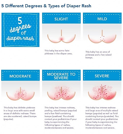 Diaper rash types discount