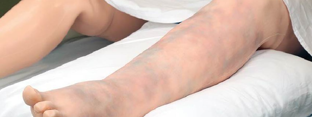 Сухой кашель и одышка? Врачи рассказали о неочевидных симптомах венозного тромбоза