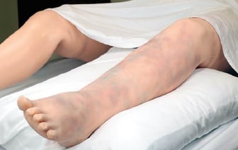 Сухой кашель и одышка? Врачи рассказали о неочевидных симптомах венозного тромбоза