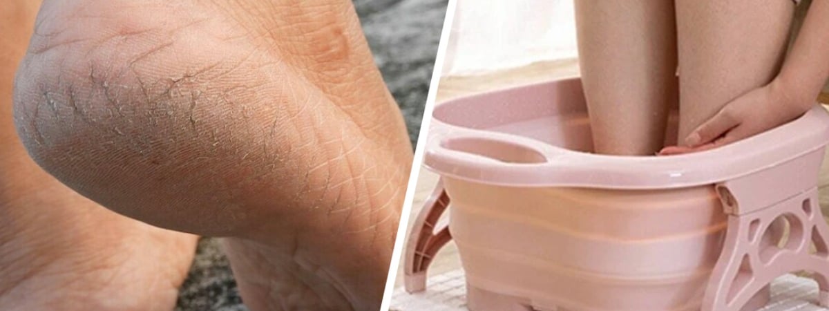 Больше никаких трещин на пятках? Это ванночка для ног с одним из видов уксуса быстро принесет облегчение — Полезно