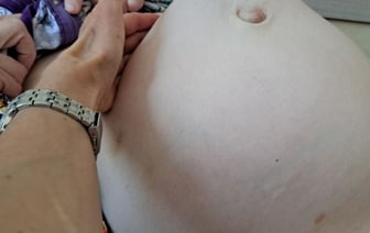 «Такие новообразования редкость». В Беларуси пациентке удалили огромную опухоль в 6 килограмм