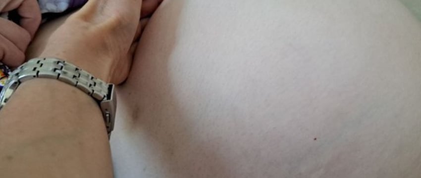 «Такие новообразования редкость». В Беларуси пациентке удалили огромную опухоль в 6 килограмм