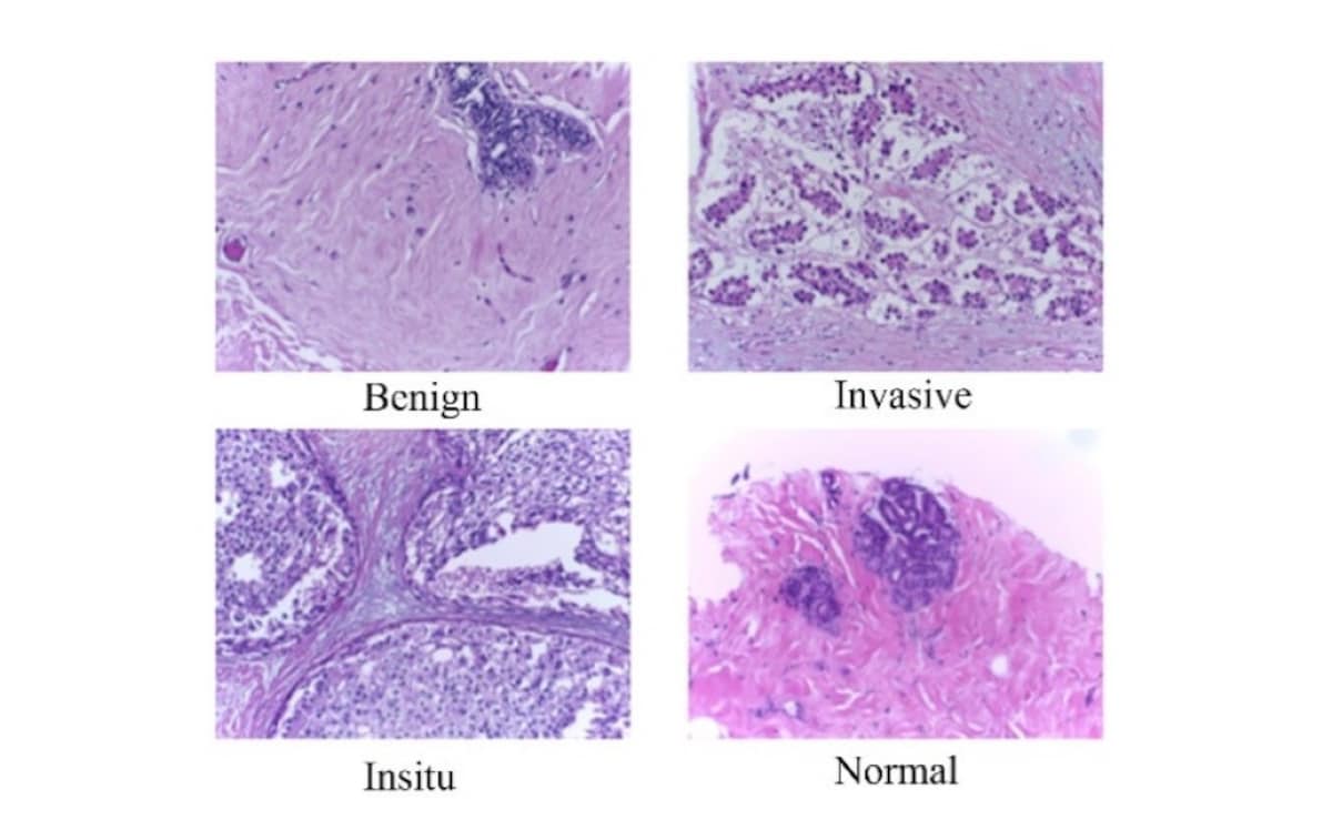 Exemplary microscopy images demonstrating the four classes in the BACH dataset (Image Source: Cancers 2024, 16(12), 2222)