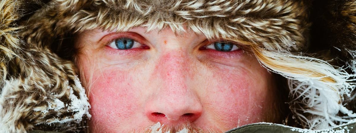 Эти 6 симптомов зимой указывают на неприятное заболевание. Как отличить аллергию на холод от обморожения? — Полезно
