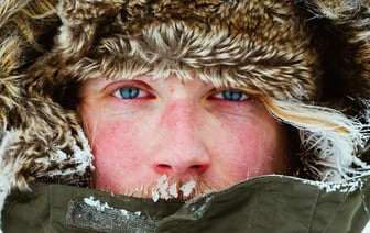 Эти 6 симптомов зимой указывают на неприятное заболевание. Как отличить аллергию на холод от обморожения? — Полезно