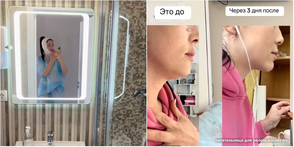 Белоруска сделала липосакцию подбородка. Сколько это стоило?