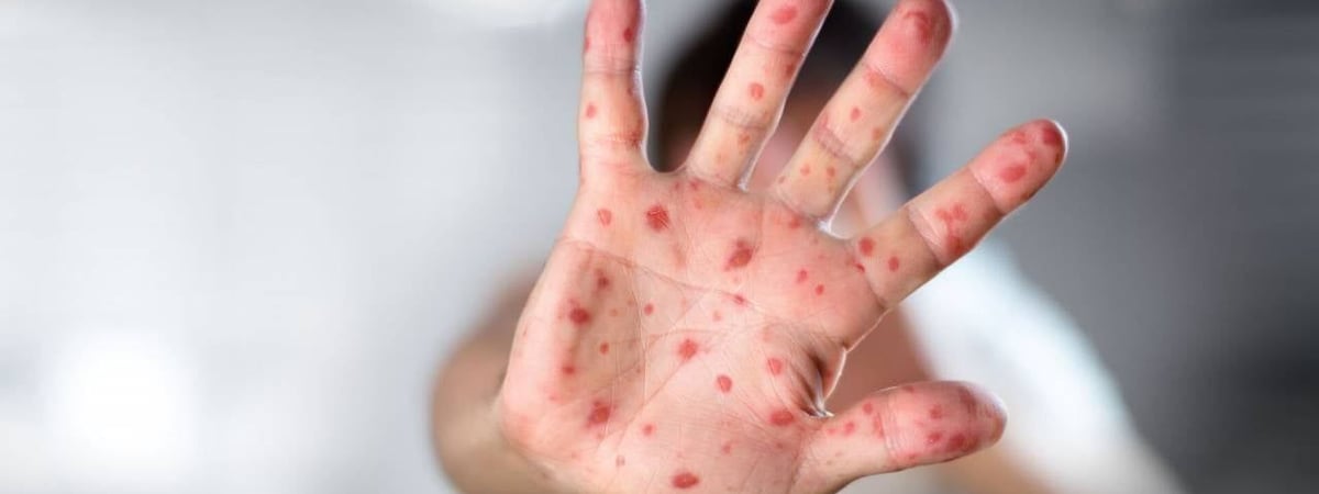 В Лидском районе подтвержден случай кори (+симптомы заболевания)