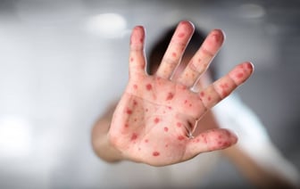 В Лидском районе подтвержден случай кори (+симптомы заболевания)