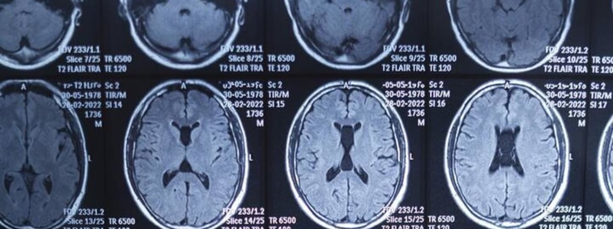 Болезнь Альцгеймера связали с вирусом герпеса