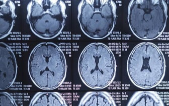 Болезнь Альцгеймера связали с вирусом герпеса