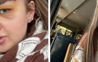 Помните белоруску, которая сделала пересадку бровей? Вот как все выглядит сейчас