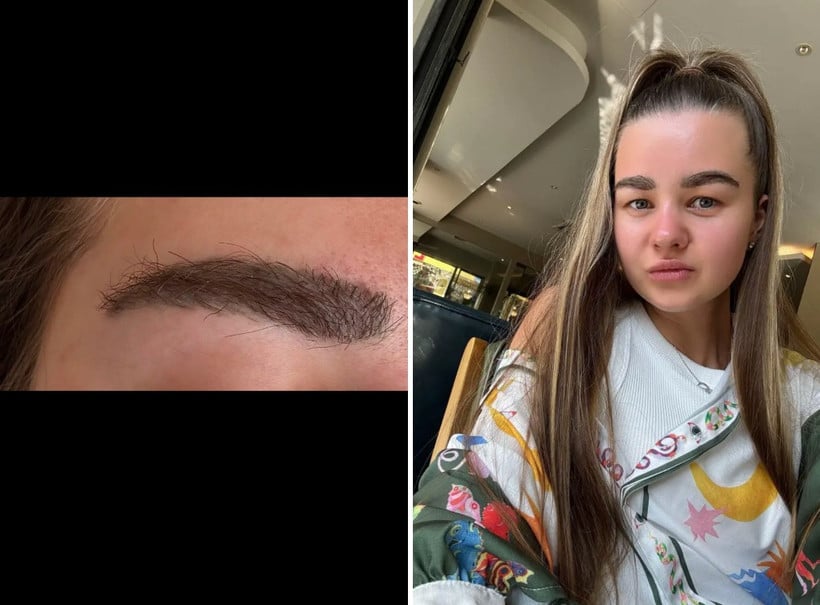 Помните белоруску, которая сделала пересадку бровей? Вот как все выглядит сейчас