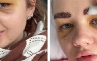 Белоруска сделала пересадку бровей. Ролик с последствиями собрал почти полмиллиона просмотров