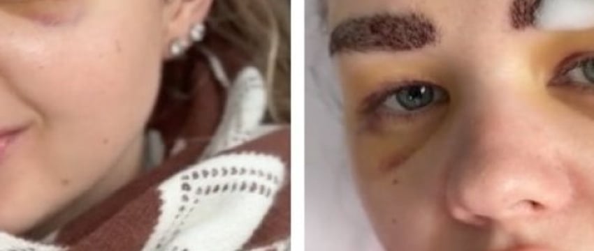 Белоруска сделала пересадку бровей. Ролик с последствиями собрал почти полмиллиона просмотров