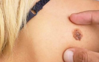 Онколог рассказал, как обнаружить опасные для жизни родинки
