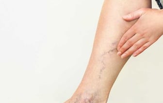 От учителя до хирурга. Люди каких профессий сильнее подвержены варикозу