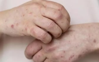 В Бресте зафиксирована вспышка кори. Почему и что делать?