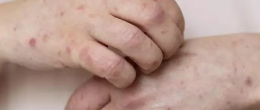 В Бресте зафиксирована вспышка кори. Почему и что делать?