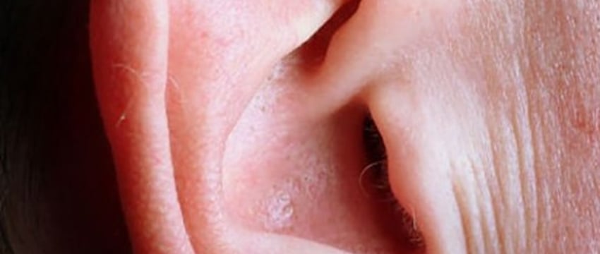 В Беларуси мужчина лишился части уха после игры в бильярд