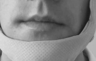 В Барановичах женщина заступалась в драке за собутыльника и получила перелом челюсти