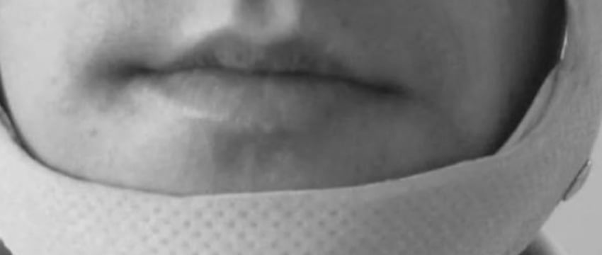 В Барановичах женщина заступалась в драке за собутыльника и получила перелом челюсти