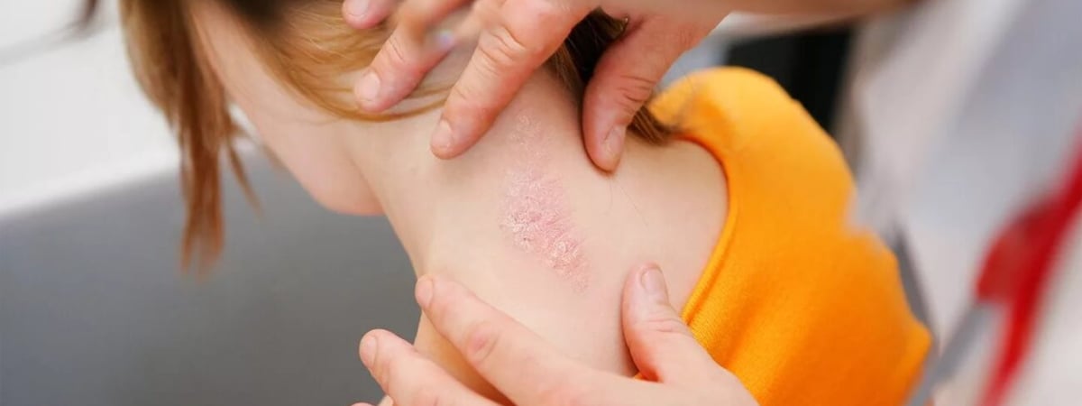 Чем опасен псориаз и как от него защититься — советы врача