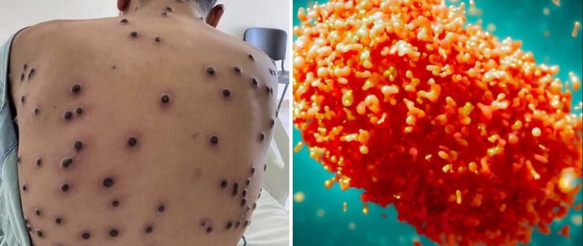 Новый штамм вируса гриппа мутирует очень быстро: как на это реагируют ученые?