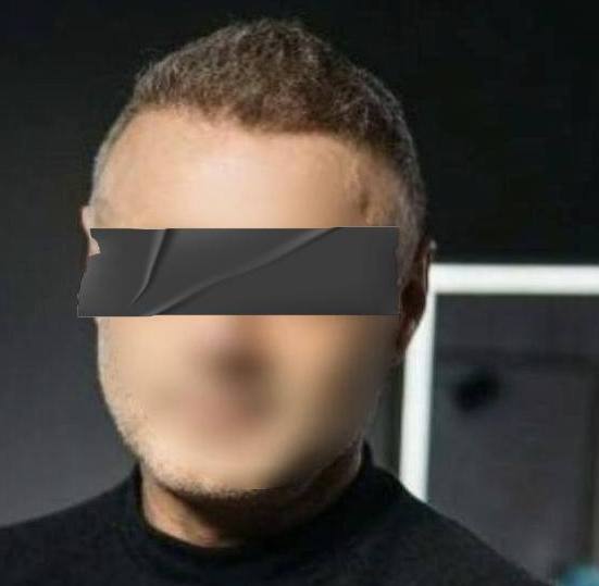 Белорус рассказал о трансплантации волос в Турции. Сколько стоит такая операция?