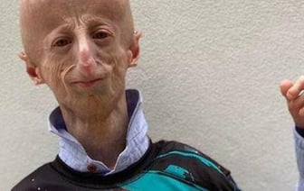 Умер самый долгоживущий человек с синдромом преждевременного старения — ему было 28 лет