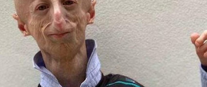 Умер самый долгоживущий человек с синдромом преждевременного старения — ему было 28 лет