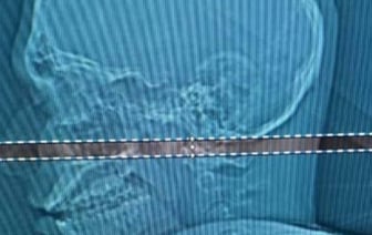 Мужчина четыре дня ходил с пулей в голове: что с ним сейчас?