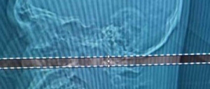 Мужчина четыре дня ходил с пулей в голове: что с ним сейчас?