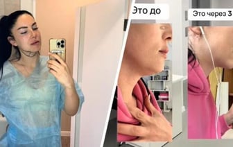 «Достали полстакана жира». Беларуска сделала липосакцию второго подбородка — сколько отдала?
