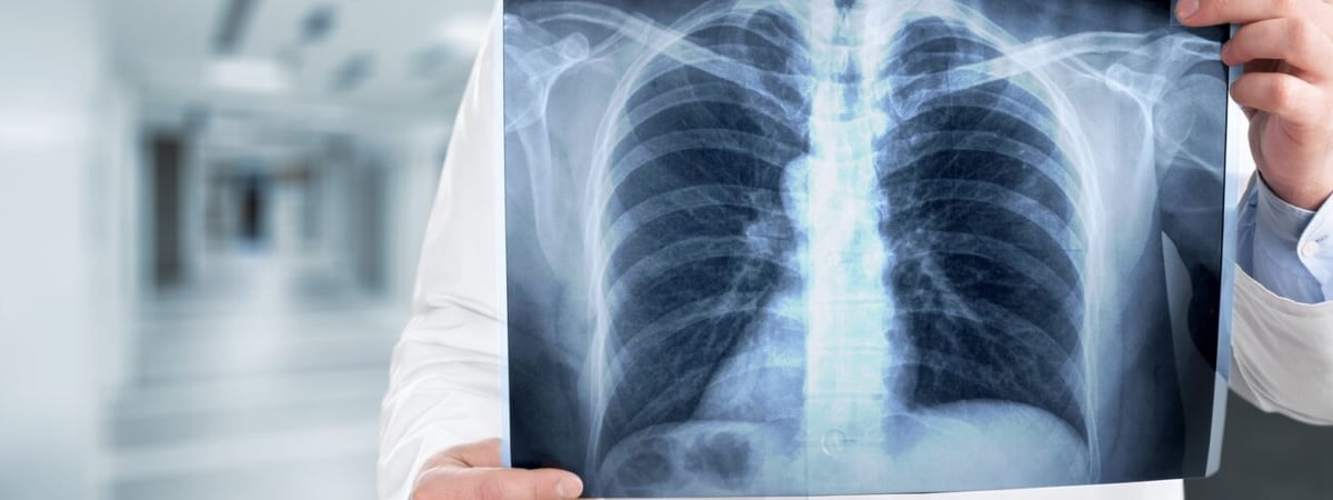 В Гродно можно будет проверить легкие бесплатно — куда обращаться