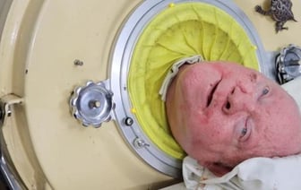 В США умер человек, более 70 лет проживший в капсуле из-за болезни