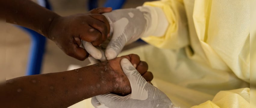 Число смертей от оспы превысило 570, поскольку в Конго ожидается вакцинация.
