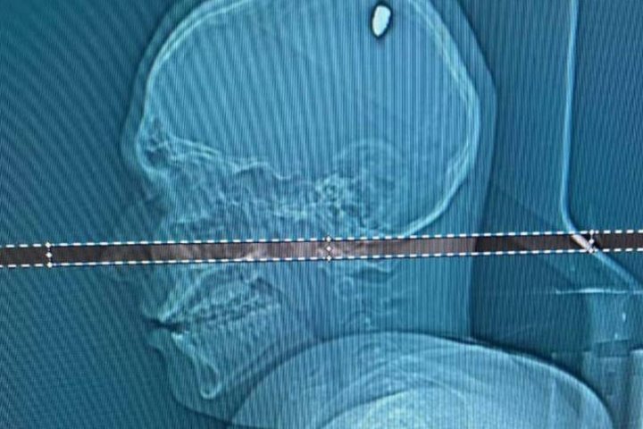 Мужчина четыре дня ходил с пулей в голове: что с ним сейчас?