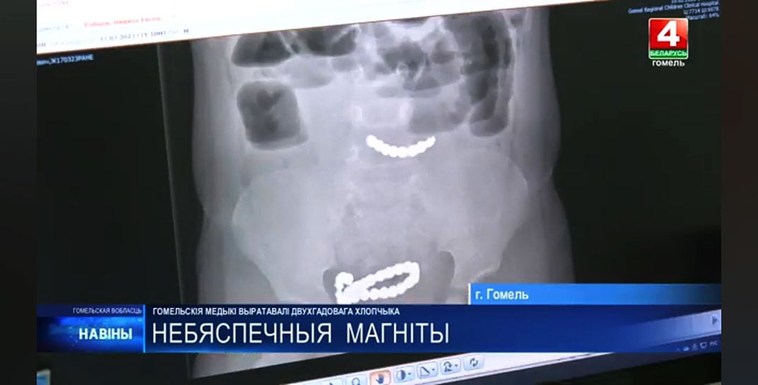 В Добруше 2-летний мальчик съел 20 магнитов — пришлось вырезать часть кишечника