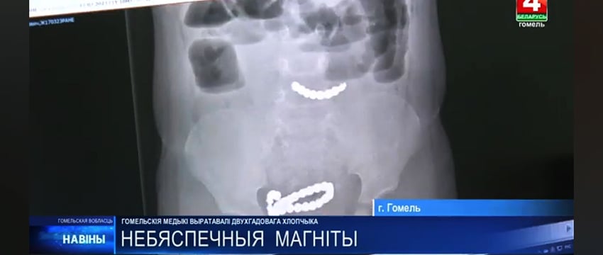 В Добруше 2-летний мальчик съел 20 магнитов — пришлось вырезать часть кишечника