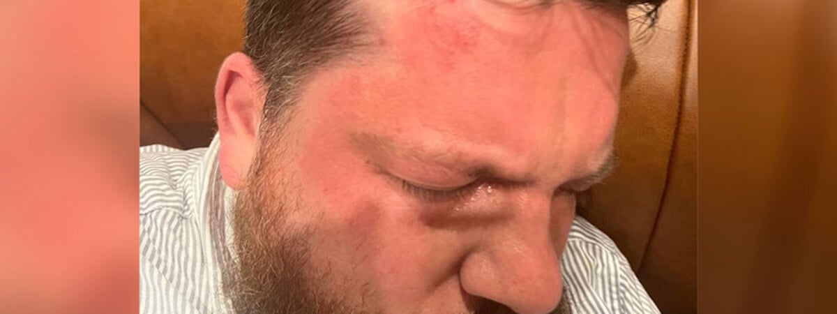 «Это был такой очевидный бандитский привет от Путина». В Вильнюсе на соратника Навального Леонида Волкова напали с молотком